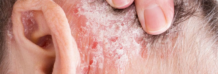 psoriasis sur le cuir chevelu